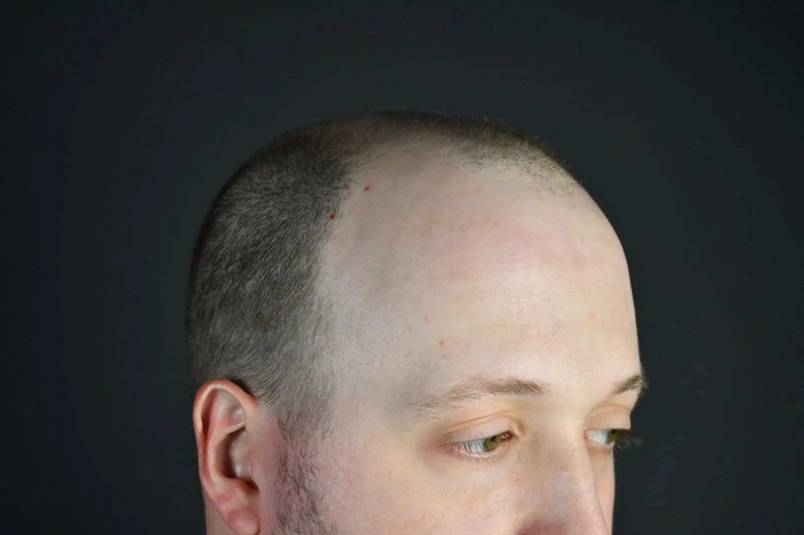 Male patient's scalp showing hair loss and skin condition against dark background
